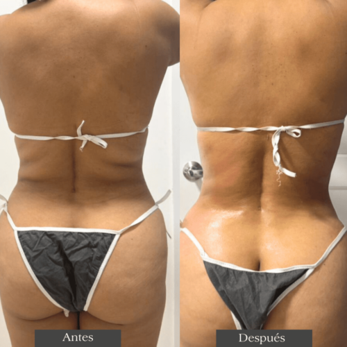 Haga clic para ver a pantalla completa Lipozero 360 photo review