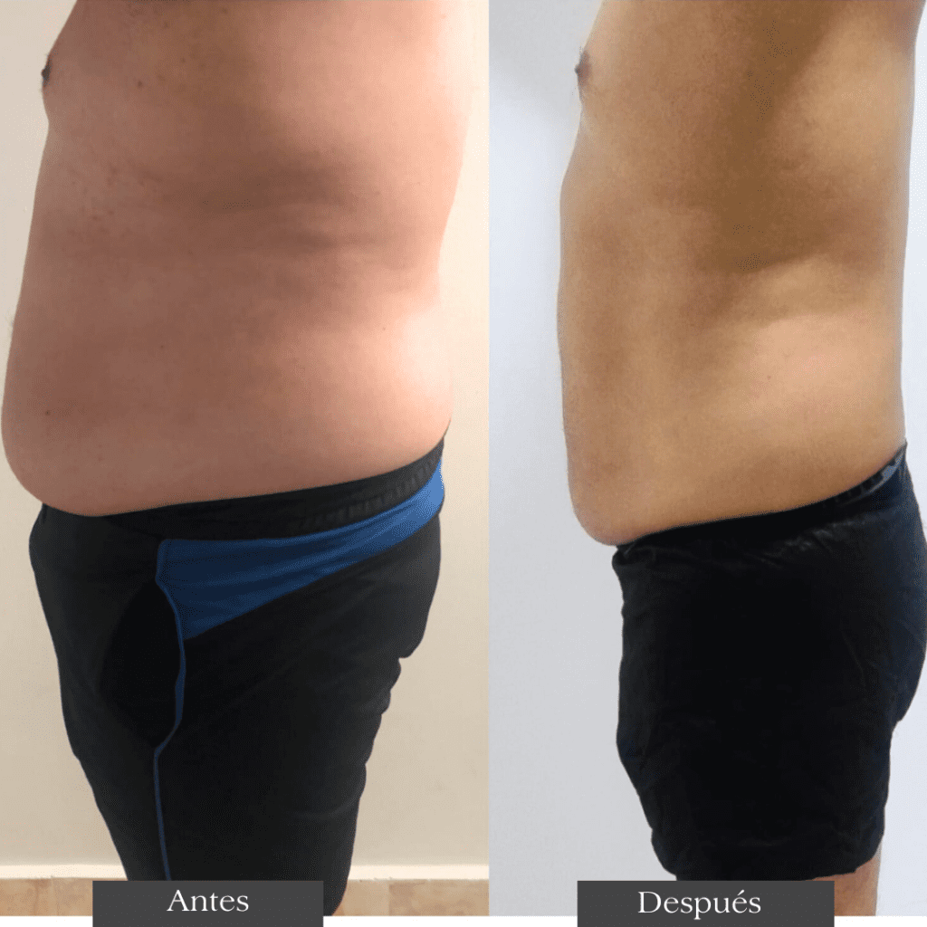 Criolipólisis (2)
