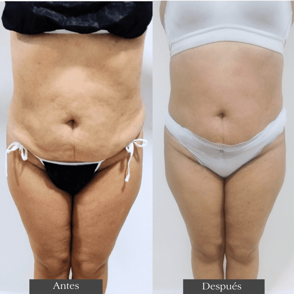 Criolipólisis (4)