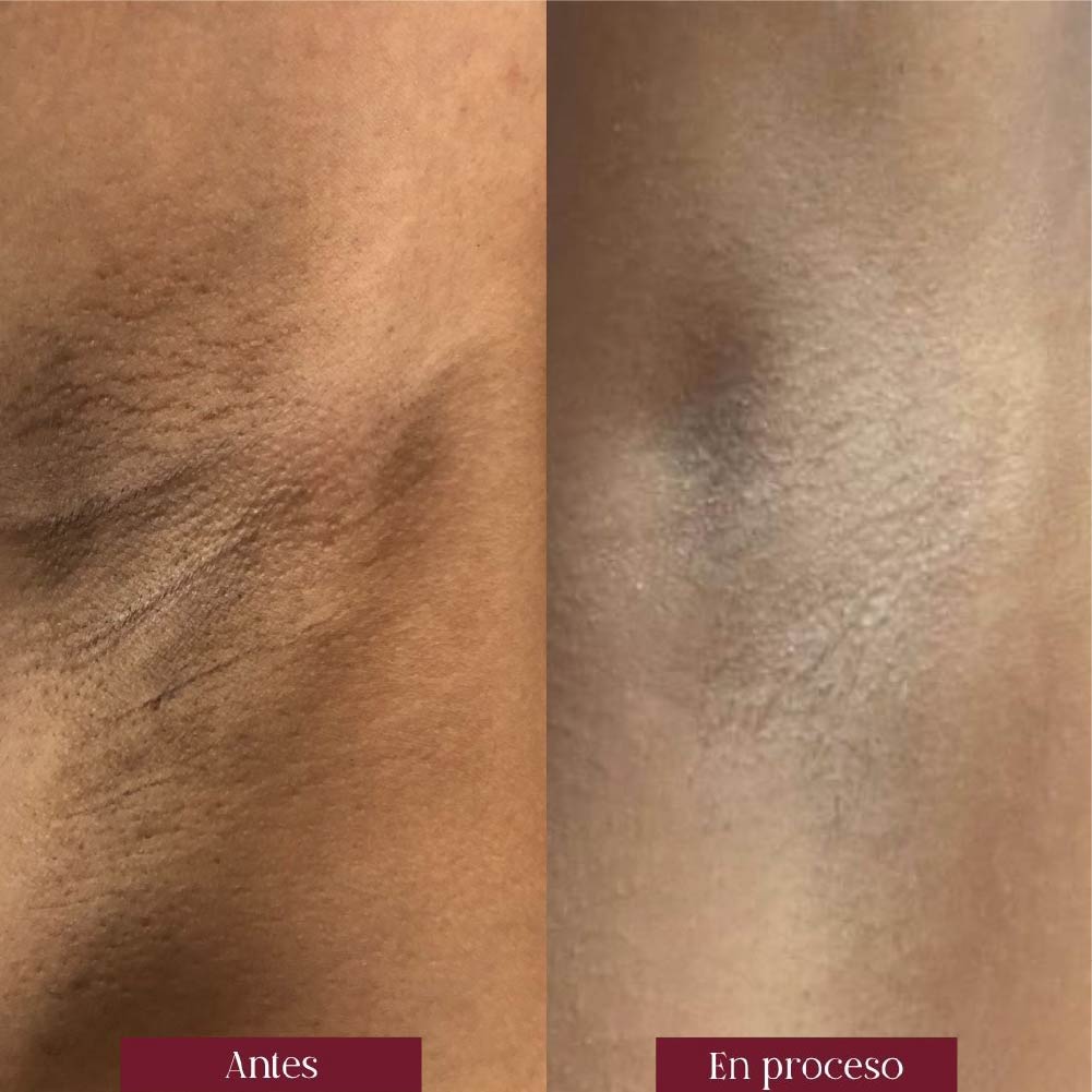 depilacion laser axilas en barranquilla