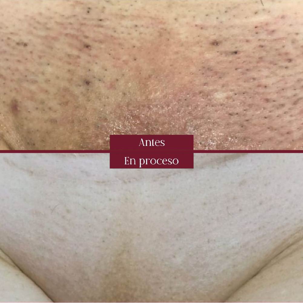 depilacion laser bikini pelvis en barranquilla sin irritacion ni dolor