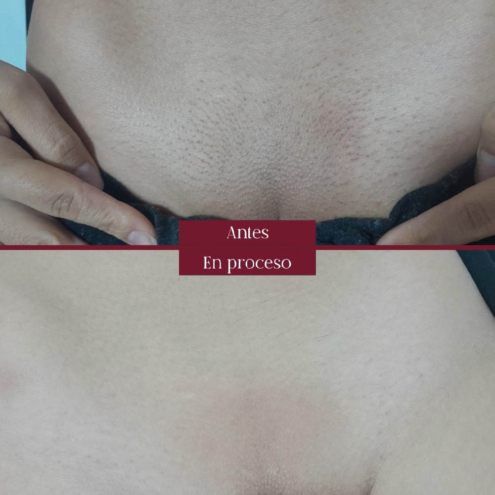 depilacion laser bikini pelvis en barranquilla