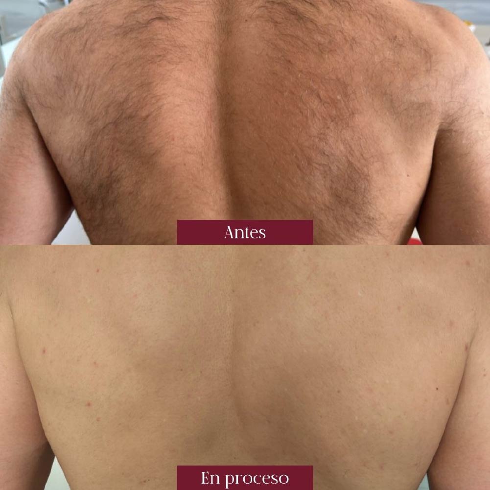 depilacion laser espalda barranquilla