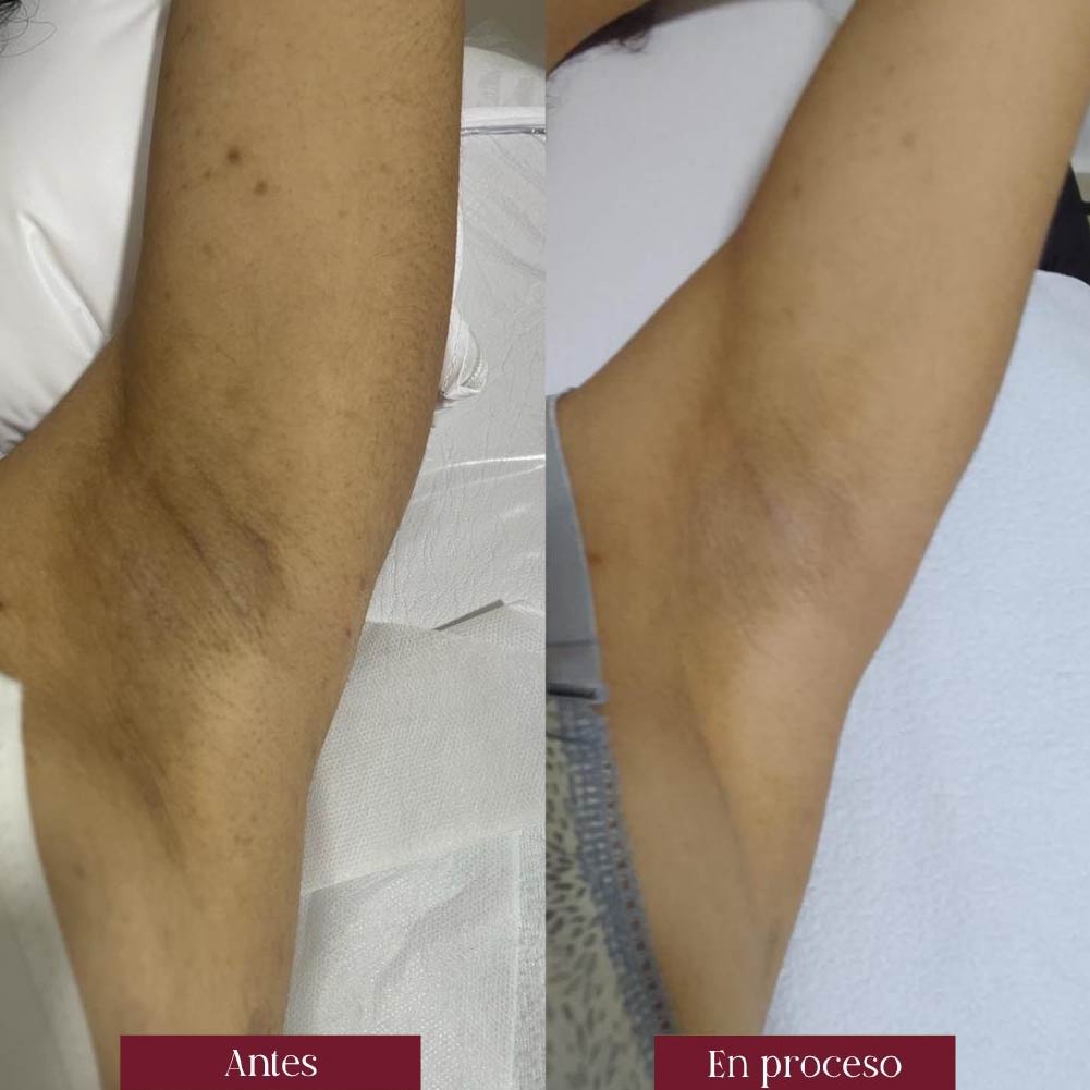 depilacion laser permanente en axilas en barranquilla