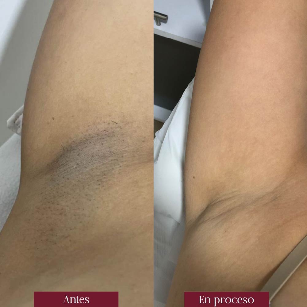 depilacion permanente de axilas con laser en barranquilla