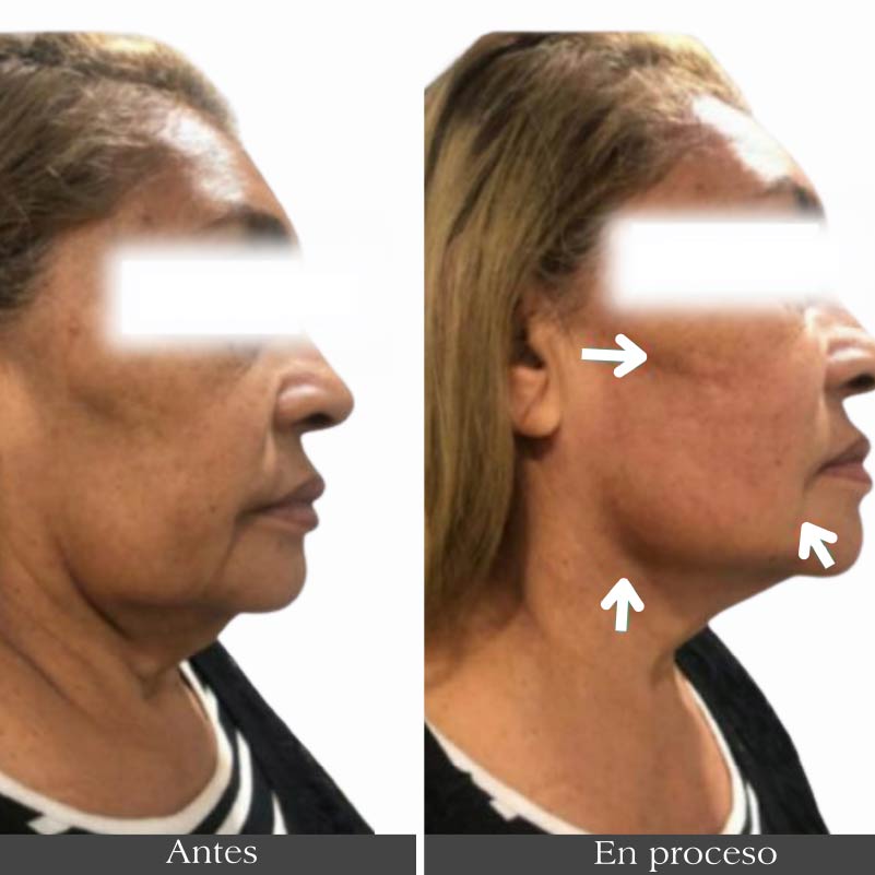 quitar arrugas en la cara con ultrahifu en barranquilla