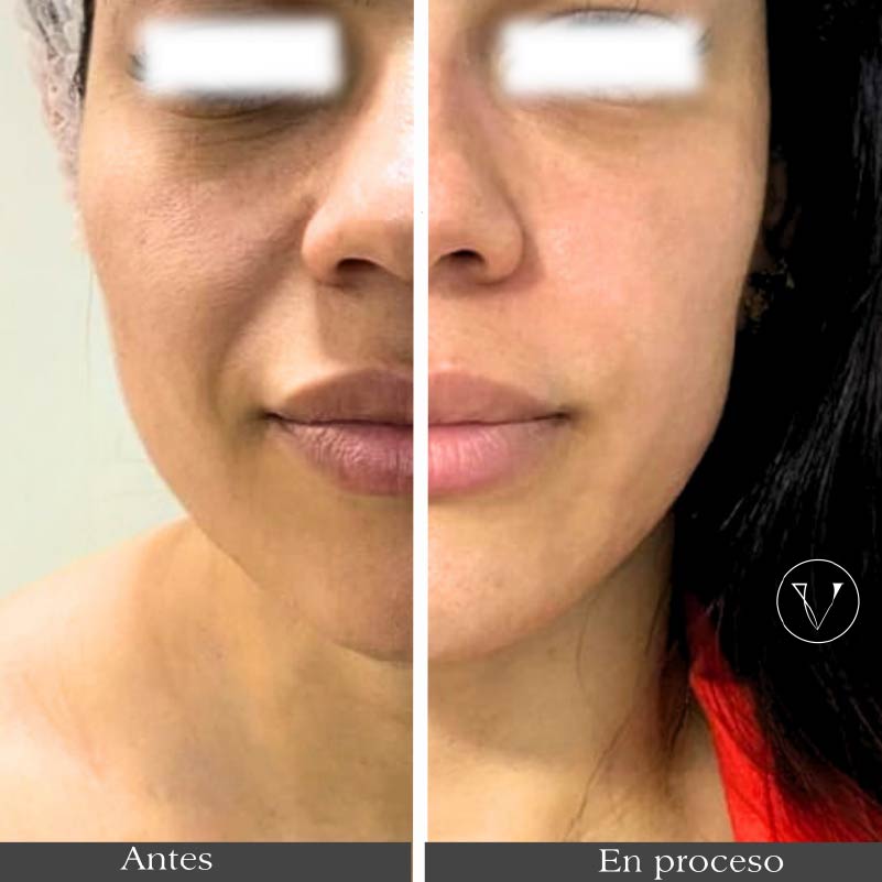 rejuvenece tu rostro con ultrahifu en barranquilla colombia