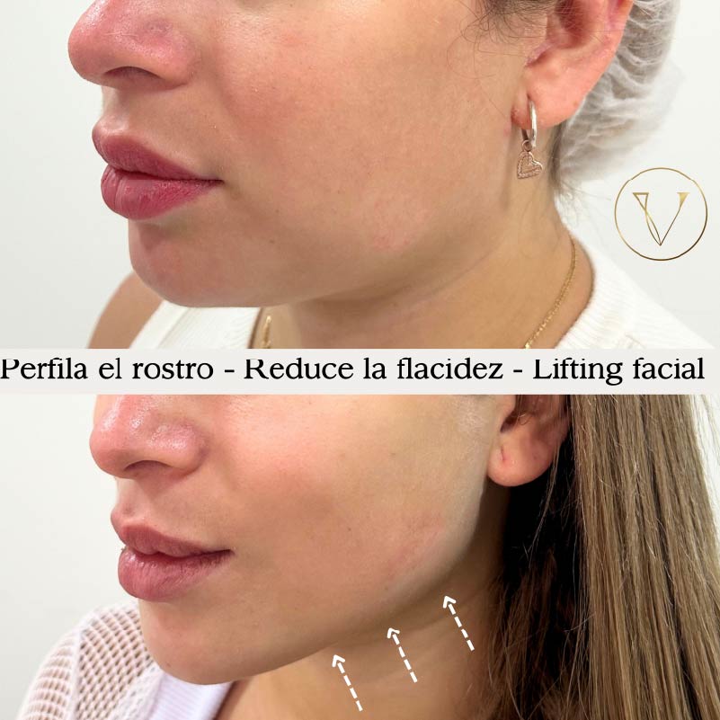 rejuvenece tu rostro con ultrahifu en barranquilla