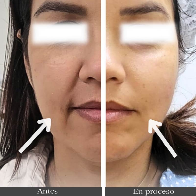 rejuvenece tu rostro con ultrahifu en barranquilla3