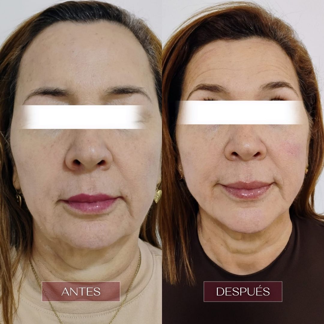 ultralaser rejuvenece tu rostro en barranquilla clinica estetica vivante barranquilla