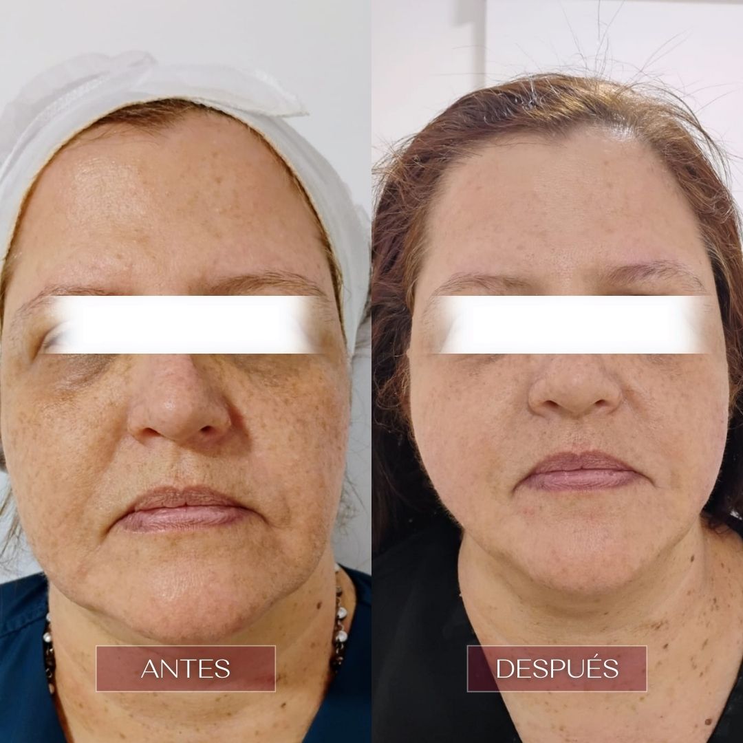 ultralaser rejuvenece tu rostro en barranquilla clinica estetica vivante barranquilla 2