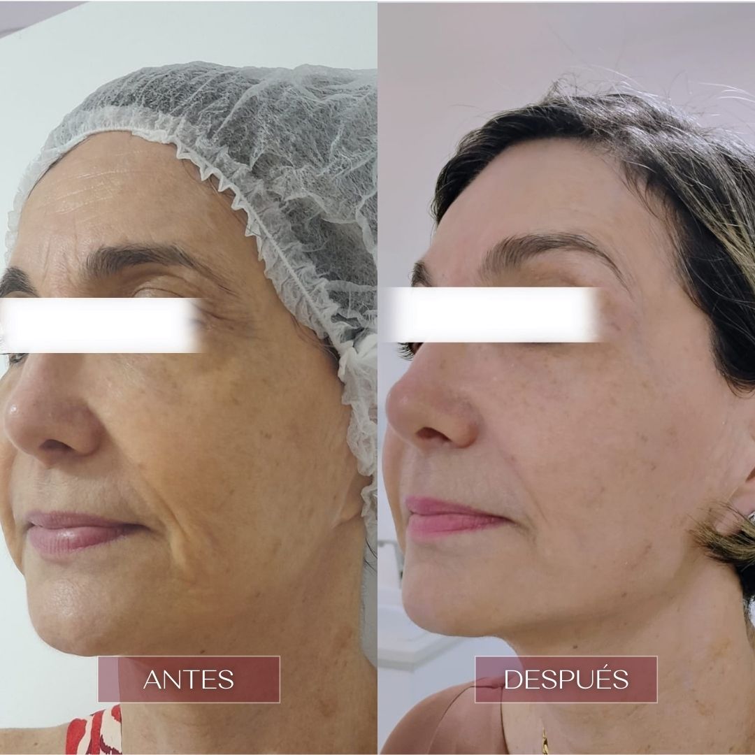 ultralaser rejuvenece tu rostro en barranquilla clinica estetica vivante barranquilla 3