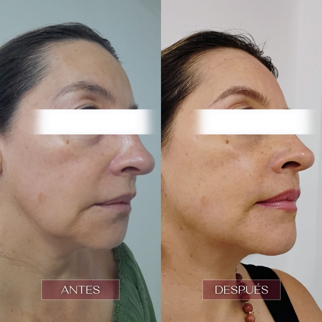 ultralaser rejuvenece tu rostro en barranquilla clinica estetica vivante barranquilla 4