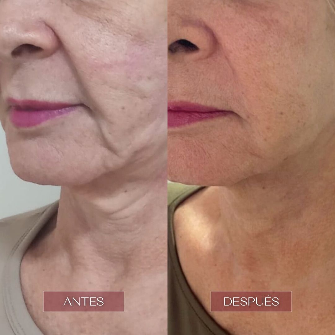 ultralaser rejuvenece tu rostro en barranquilla clinica estetica vivante barranquilla 5