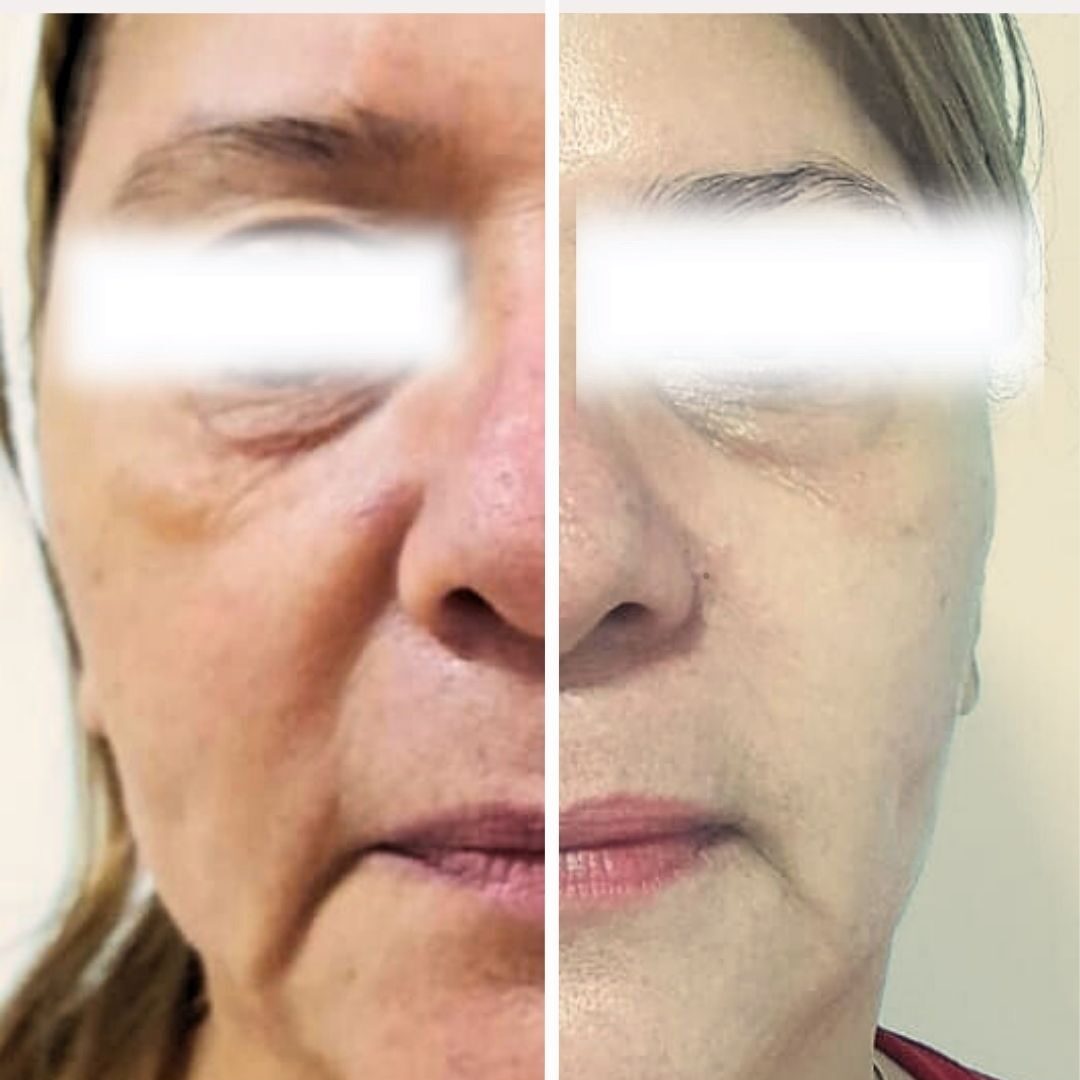 ultralaser rejuvenece tu rostro en barranquilla clinica estetica vivante barranquilla 6